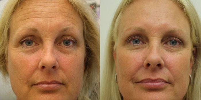 Rostro de mujer antes y después del levantamiento SMAS