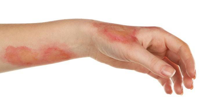 Quemaduras en el brazo
