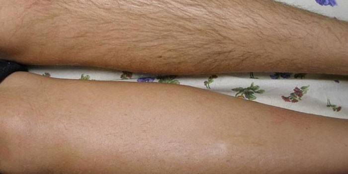 Piernas antes y después de la electrólisis.