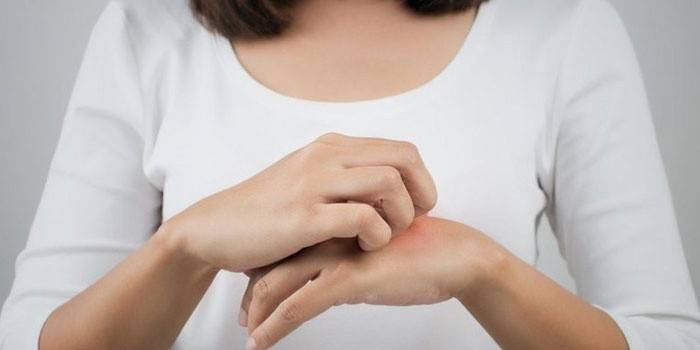 Mulher coça uma picada de mosquito na mão dela