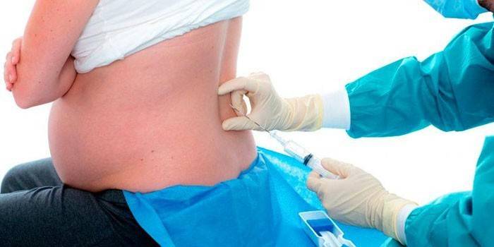 Anestesia Epidural Grávida