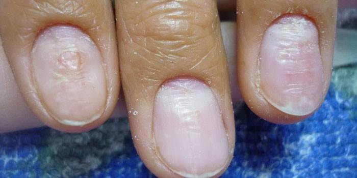Unhas deformadas