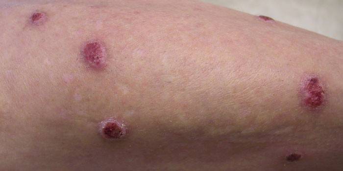 Urticaria papular en la piel de la mano.