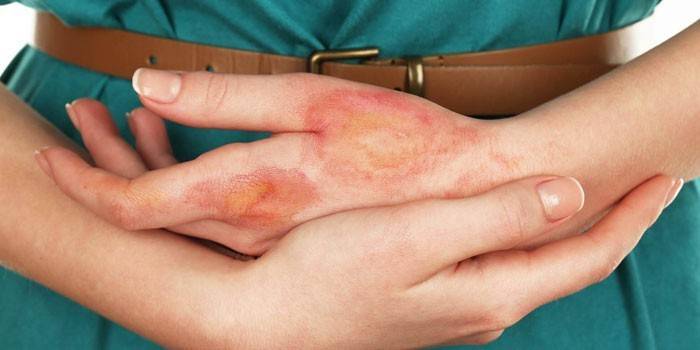Dermatitis en el brazo de una mujer.