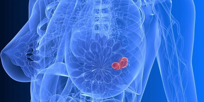 Tumor de mama