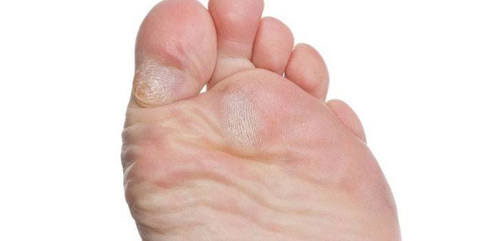 Micosis del pie