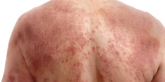 Urticaria colinérgica en la piel de la espalda.