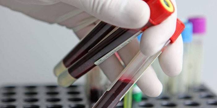 Tubos de ensayo con análisis de sangre en la mano.