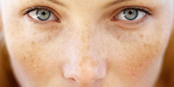 Chica con pecas en la cara.