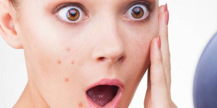 Acne nas bochechas de uma mulher