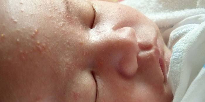 Çocuğun yüzündeki hormonal döküntü