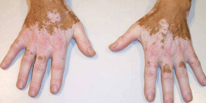 Vitiligo po ruke