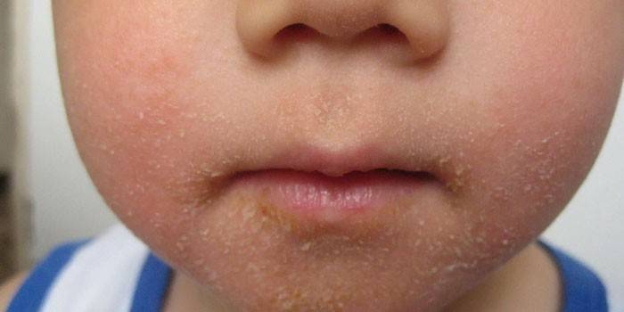Streptoderma no rosto de uma criança