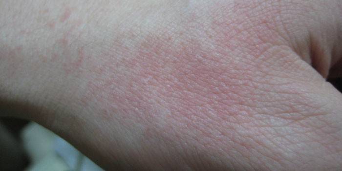 Alergia na zimno pod ręką