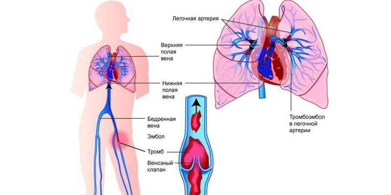 Tromboembolismo Pulmonar