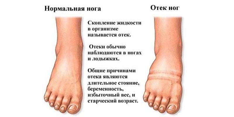 Bacak ödeminin nedenleri
