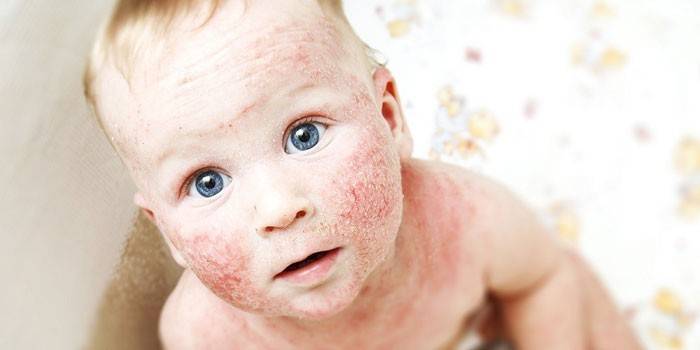 Dermatite atópica nas bochechas de uma criança