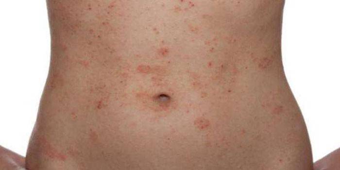 Dermatitis alérgica en el cuerpo