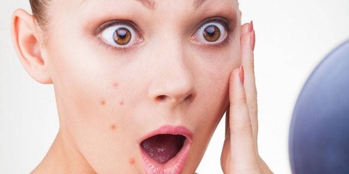 A garota tem acne no rosto