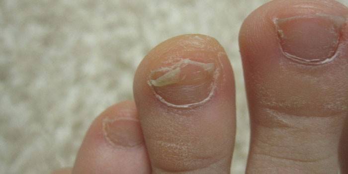 Unhas do fungo afetadas em uma criança