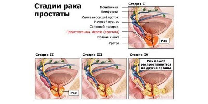 Etapas del cáncer de próstata