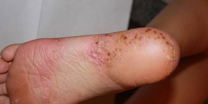 Psoriasis pustulosa en el pie.