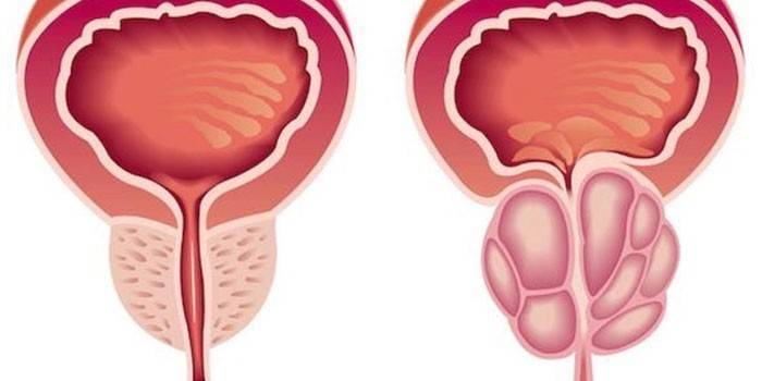 Esquema de uma próstata saudável e inflamação da próstata
