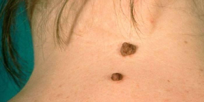 Nevus na szyi kobiety