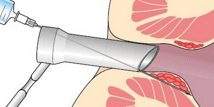 Escleroterapia para hemorroides