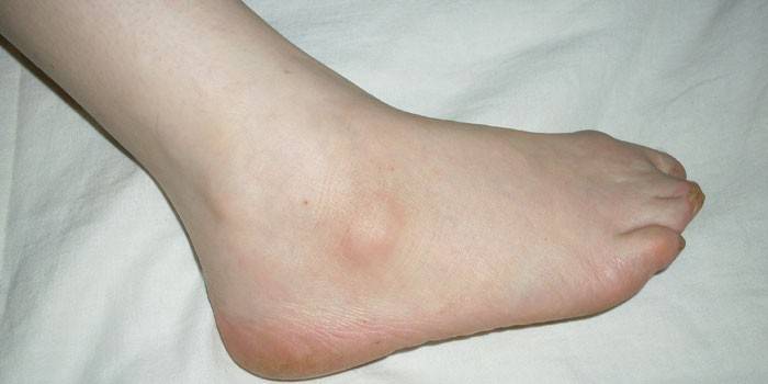 Lipoma na perna