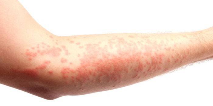 Urticaria en la piel de la mano.