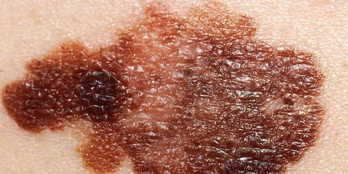 Melanoma na pele