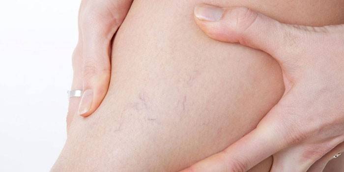 Rede vascular na perna de uma mulher