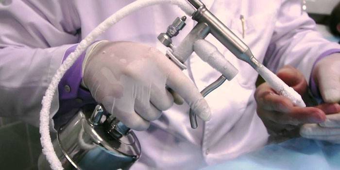 Doctor con un dispositivo criogénico en sus manos