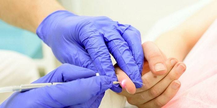O médico faz a remoção a laser de papilomas da pele do dedo do paciente
