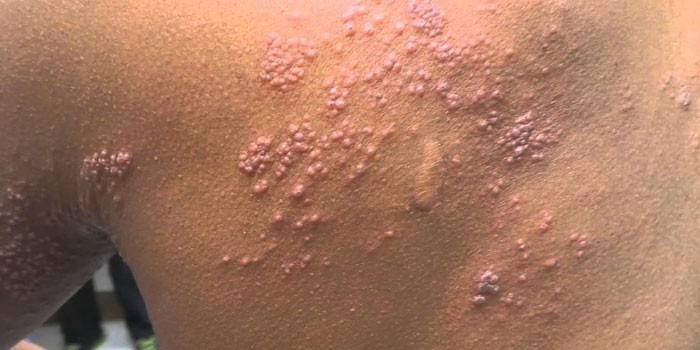 Pele afetada pelo herpes zoster
