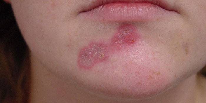 Neurodermatite no rosto de uma mulher