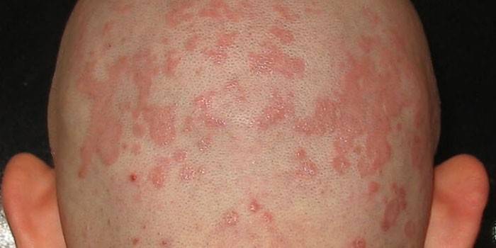 Prejavy seboroickej dermatitídy pokožky hlavy u človeka