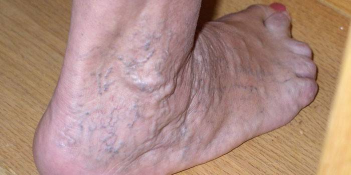 Trombose venosa profunda na perna