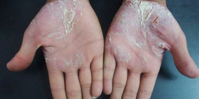 Manifestaciones de psoriasis en las palmas.