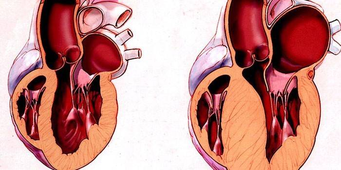 Coração saudável e cardiomiopatia hipertrófica