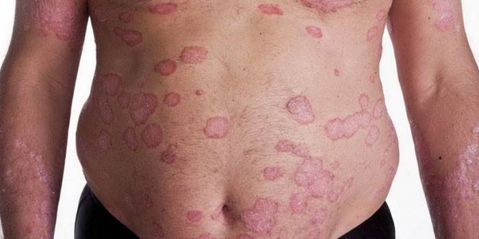 Psoriatické plaky na tele človeka