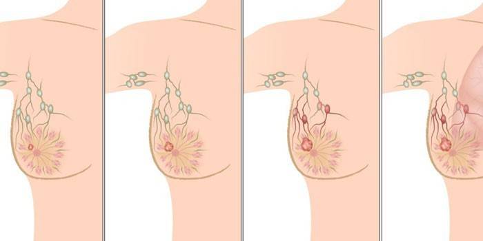 Etapas del cáncer de seno