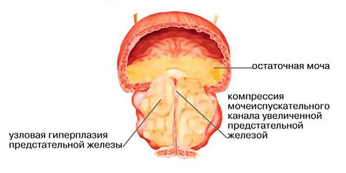 Schéma adenómu prostaty