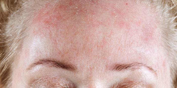 Urticaria fría en la frente de una mujer