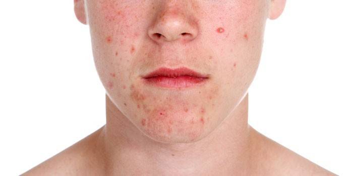 Acne no rosto