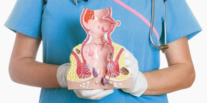 El modelo de hemorroides en manos de un médico.