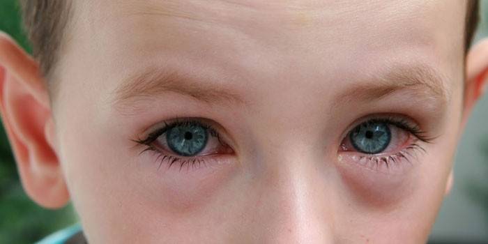 Hinchazón de los ojos en un niño.