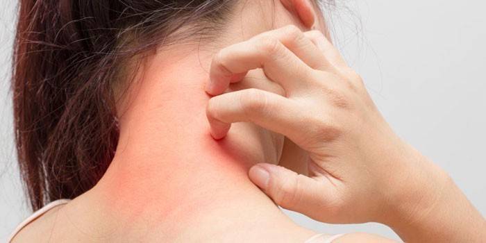 La niña se rasca la piel del cuello.