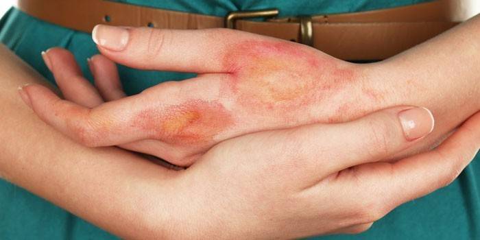 Dermatitis ampollosa
